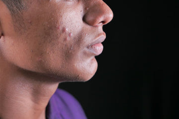 Electric Shavers and Acne: Do They Cause Breakouts? (2026 Guide)